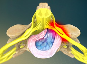 Herniated Disc